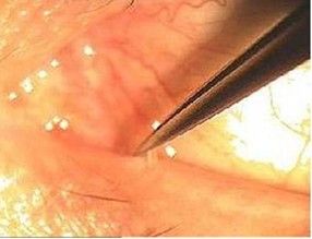 眼睛干涩怎么办人工泪液,眼睛干涩怎么办按摩哪个穴位