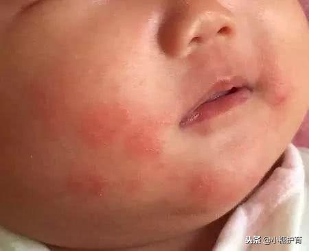 口水疹是什么原因引起的,为什么宝宝口水疹反复