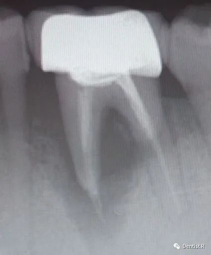 看牙为什么要拍照片,看牙拍片辐射大吗