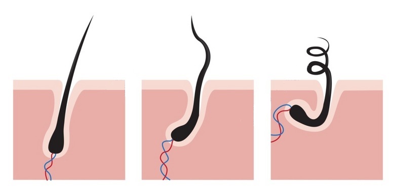 毛囊萎缩退化会脱发？教你三个方法，判断毛囊是否还活着