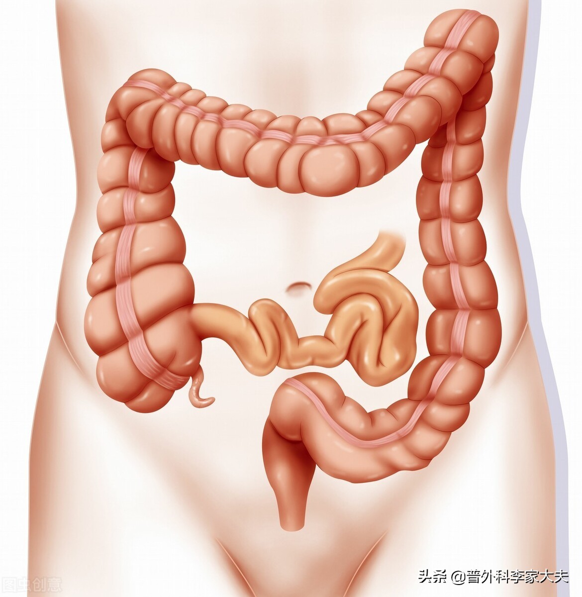 肠癌体质风险因素，来讨论直肠该如何保肛？