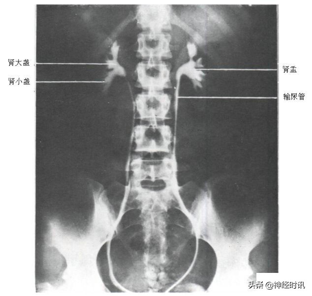 肾脏输尿管膀胱前列腺结构,肾输尿管膀胱解剖示意图
