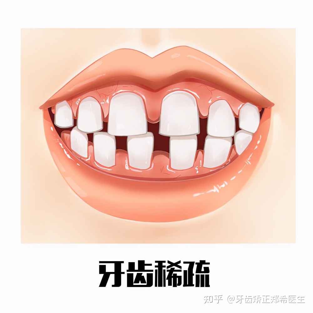 石家庄牙齿矫正视频,牙齿严重不齐矫正成功案例