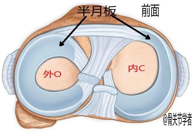 磁共振图片讲解半月板损伤的程度,磁共振半月板损伤严重