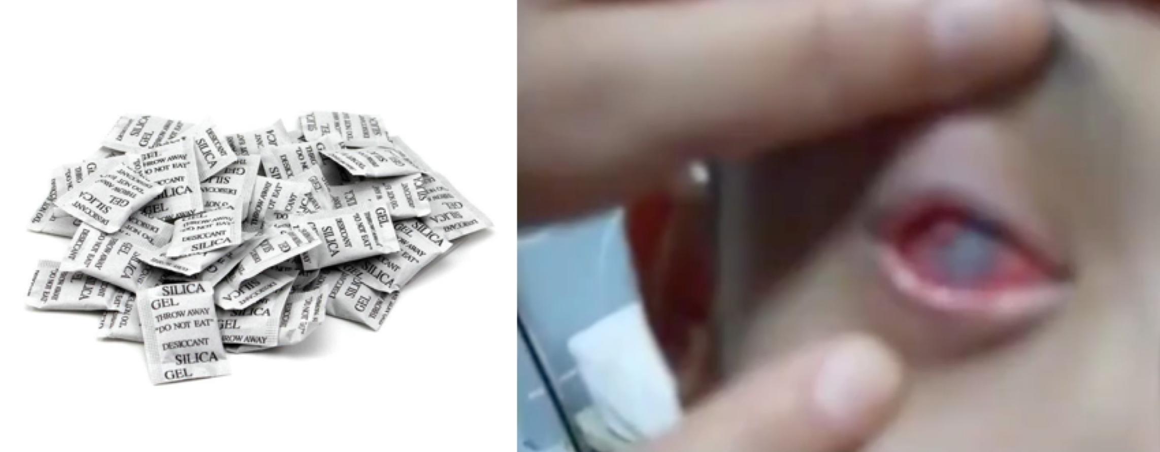 8岁男孩吹干燥剂眼球溶解了,小孩玩干燥剂眼睛被溶掉的图片