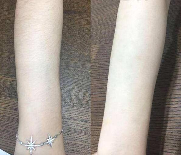 用烟酰胺脸毛会越来越长吗,烟酰胺停止使用脸上的黑毛会好吗