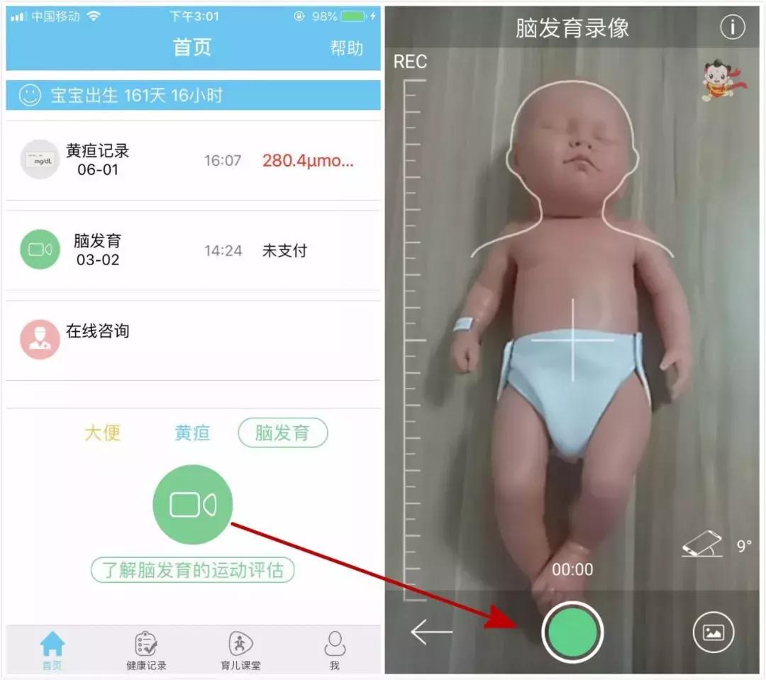 黄疸脑损伤能恢复正常吗,新生儿黄疸轻微脑损伤怎么治疗