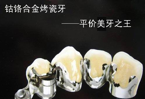 牙冠的常见种类与区别,牙冠什么种类性价比高