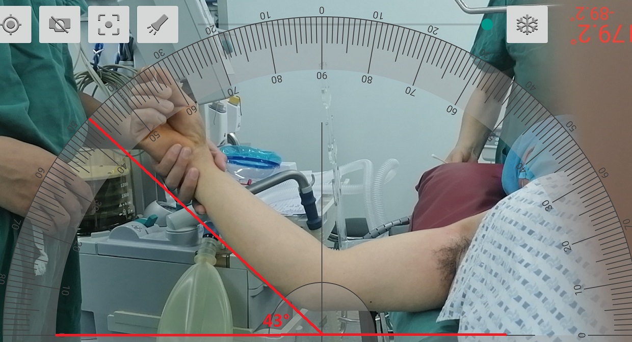 肘关节僵硬手术松解后一直有积液,肘关节僵硬异位骨化必须做松解吗