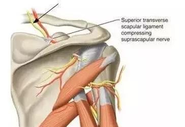 中医怎么看肩膀冈上肌疼痛,肩膀冈上肌疼痛