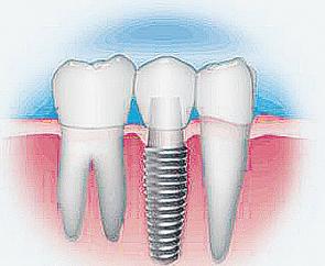 种植牙科普知识海报,种植牙齿的冷知识