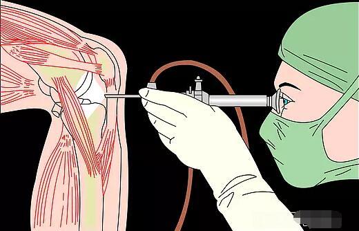 干细胞彻底治关节炎吗,干细胞真的能够治疗骨关节炎吗