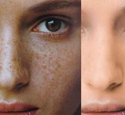 雀斑真的无药可救了吗,雀斑用中药真的能去除吗