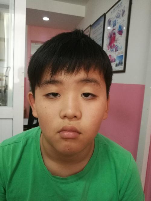 家长们注意:儿童上睑下垂,不能忽视!
