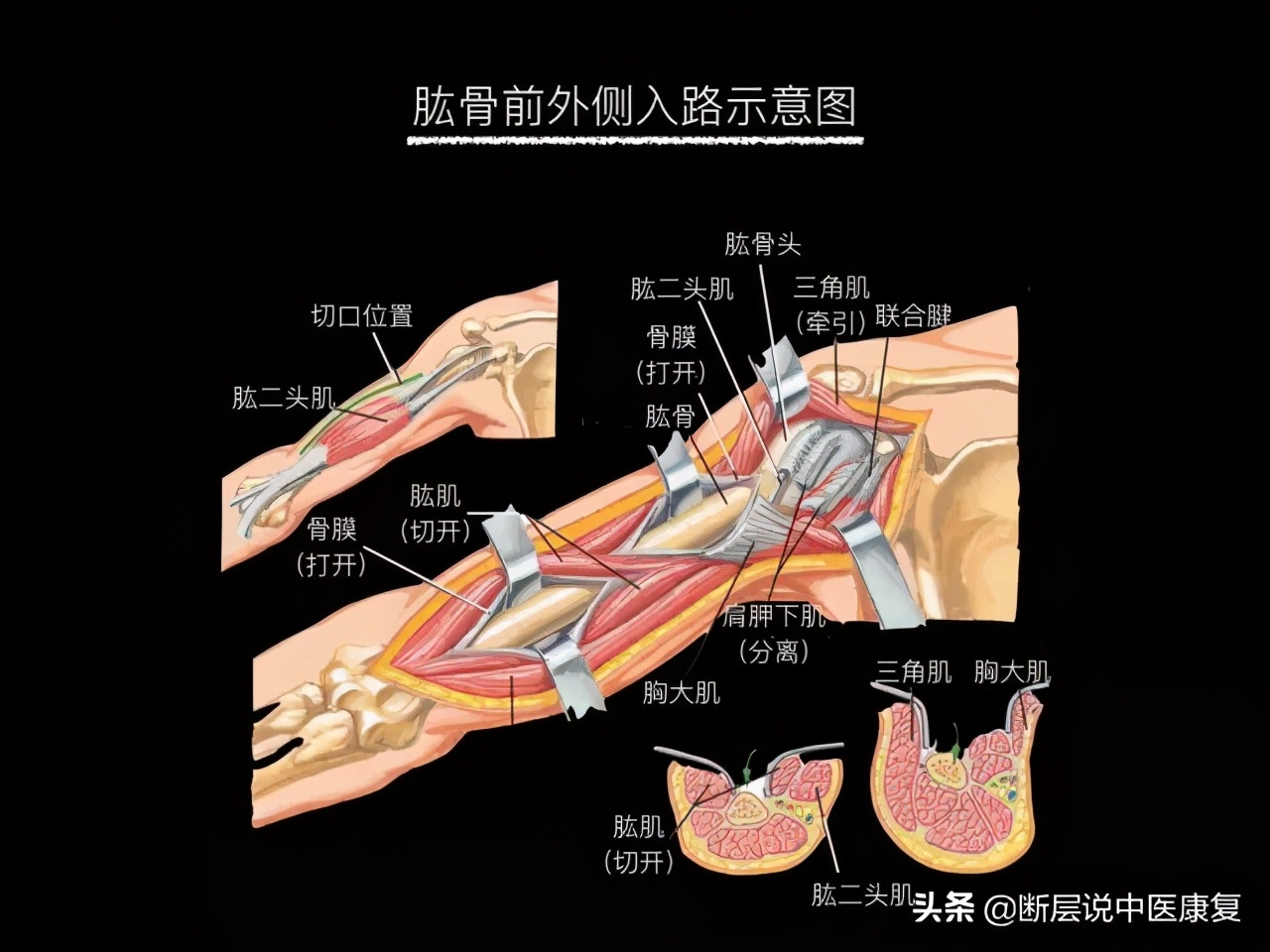 手臂人体解剖图讲解,手臂上举3d肌肉解剖讲解