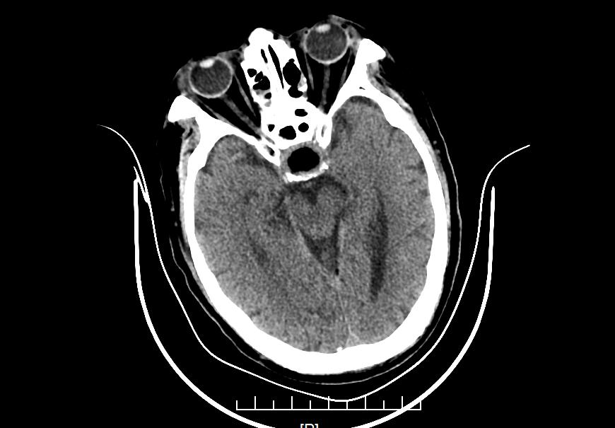 眼突然模糊看不清与大脑有关吗,长时间看不清东西眼睛会变小吗