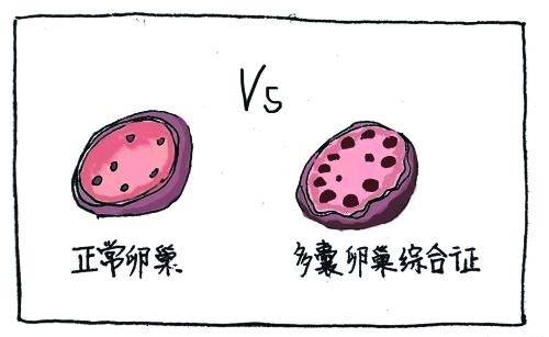 多囊卵巢综合症为什么会导致不孕,长痘多囊