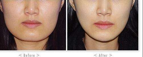 瘦脸针打一次能够达到瘦脸效果吗,瘦脸必看哪些人群不适合瘦脸针