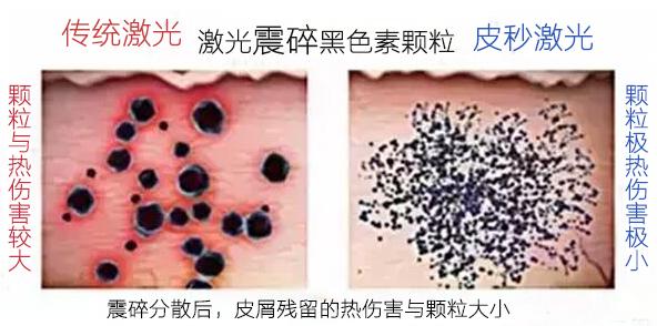 激光皮秒祛斑为什么会反黑,皮秒激光祛斑后怎么预防反黑