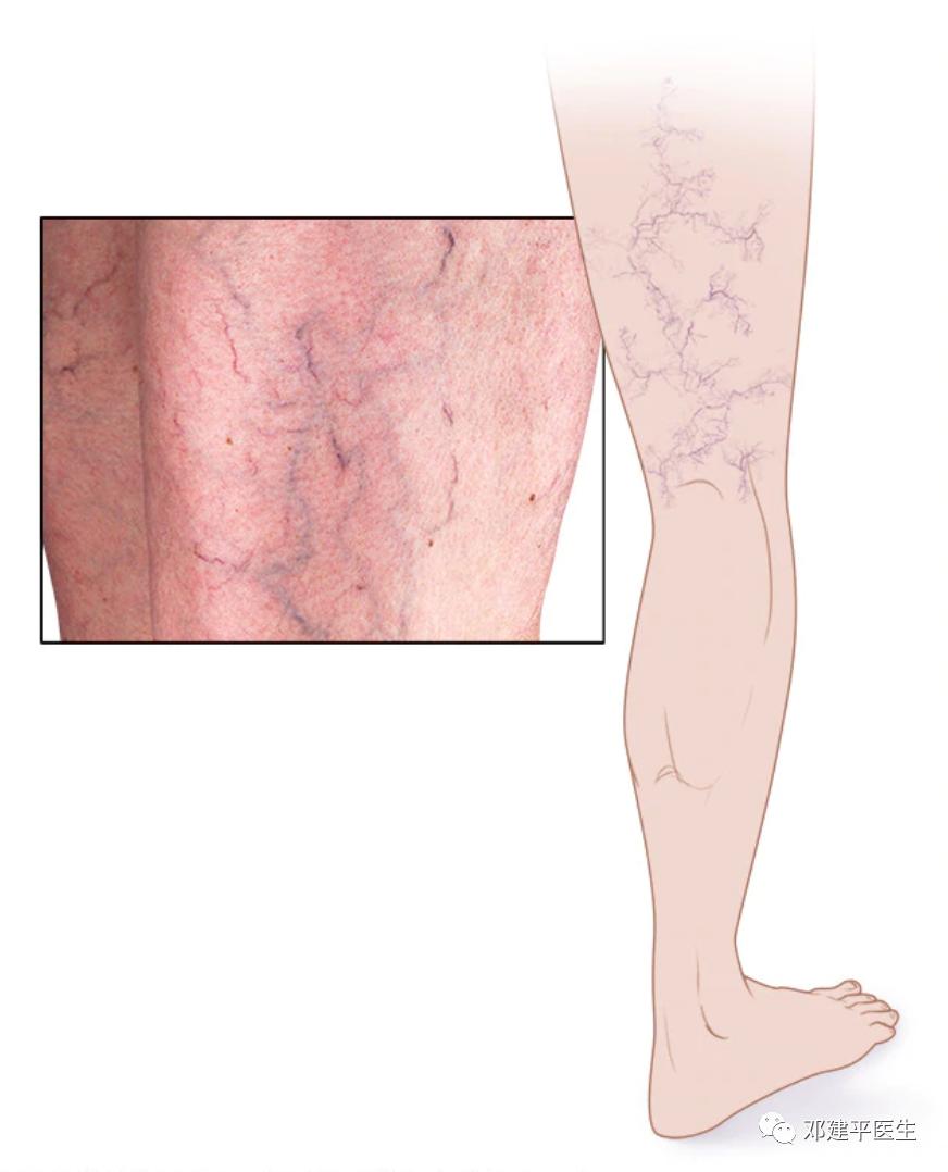 什么是毛细血管扩张,什么是毛细血管