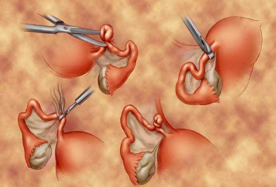 除了放环和结扎还可以怎么避孕,避孕失败后去上环能避免怀孕吗