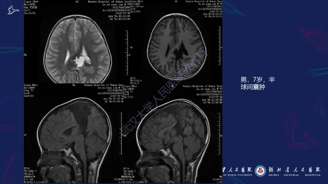 胼胝体肿瘤影像鉴别,胼胝体病变影像诊断