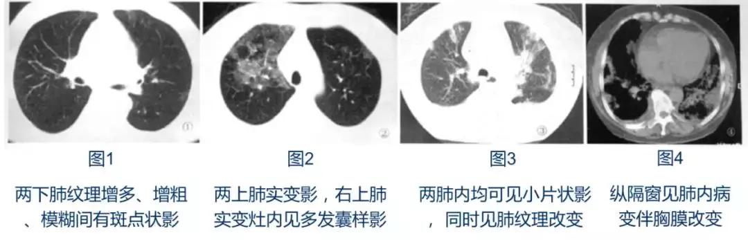 怎样确诊肺部真菌感染,侵袭性肺真菌病的确诊标准有哪些
