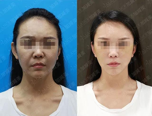 法令纹深显老十岁怎么解决,法令纹真的可以靠五招改善吗