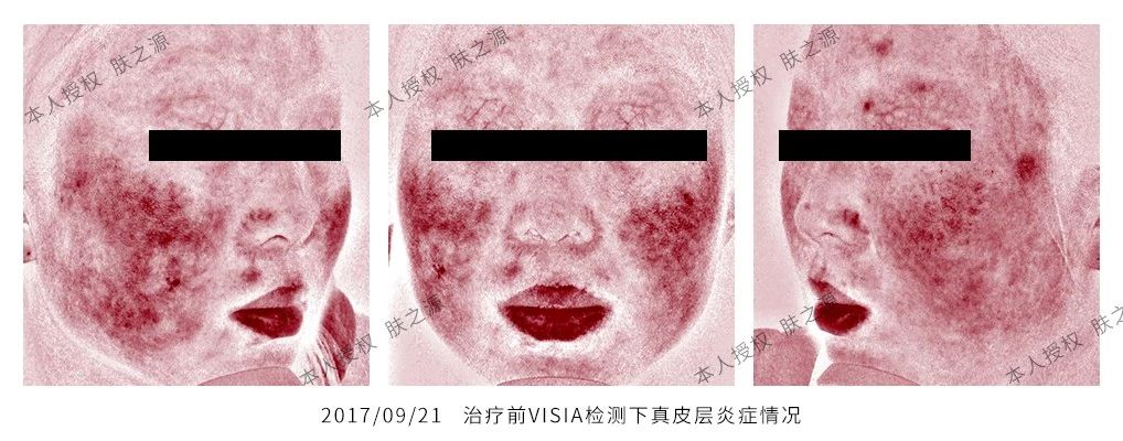 玫瑰痤疮患者自述,治疗玫瑰痤疮案例分享