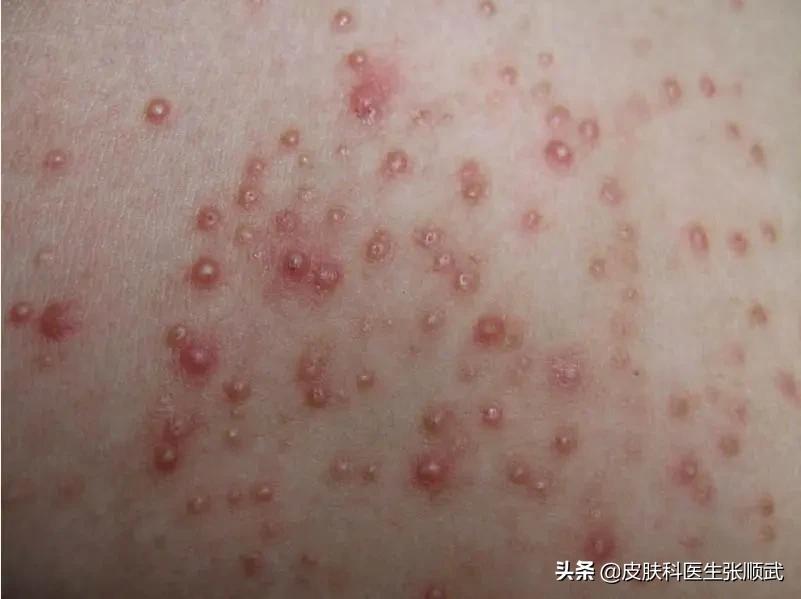 毛囊炎起大疙瘩里面流脓,毛囊炎肿大有脓怎么治