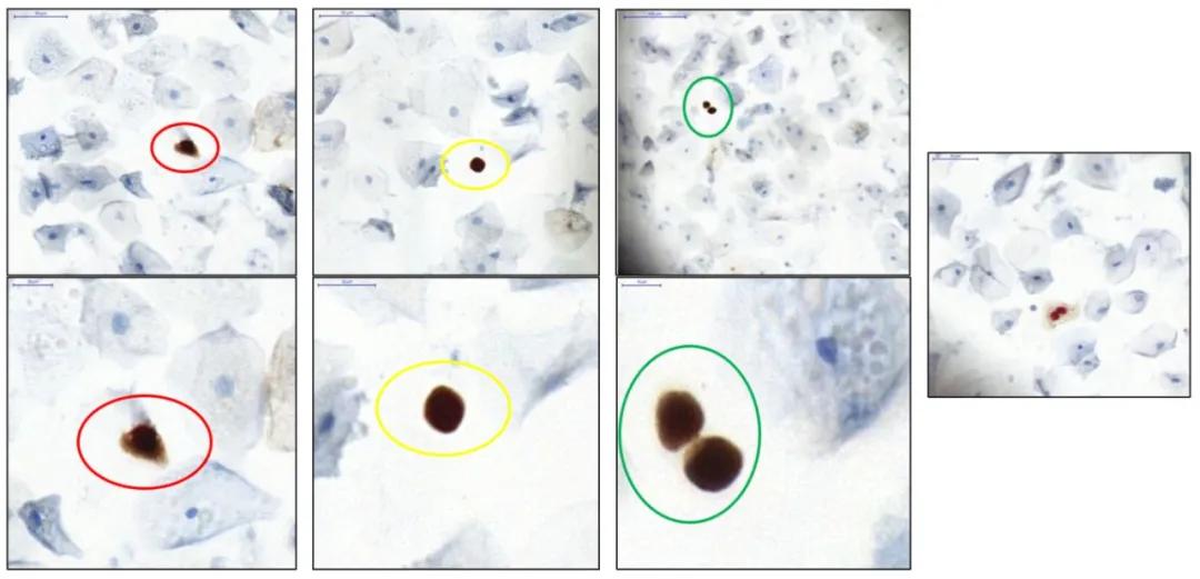 「一路有理」优化诊断，让高级别病变不再“隐形”