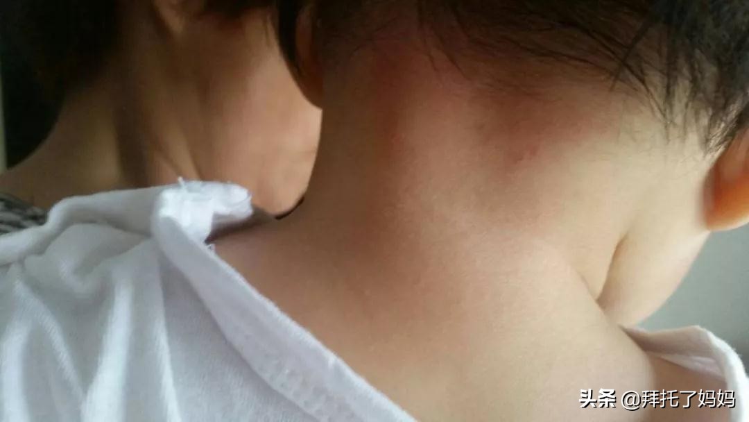 预防痱子小窍门,热痱和痱子的区别