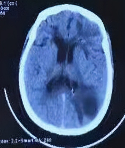 不做穿刺引流肝脓肿一般能好吗,大脑有囊肿需要做开颅手术吗