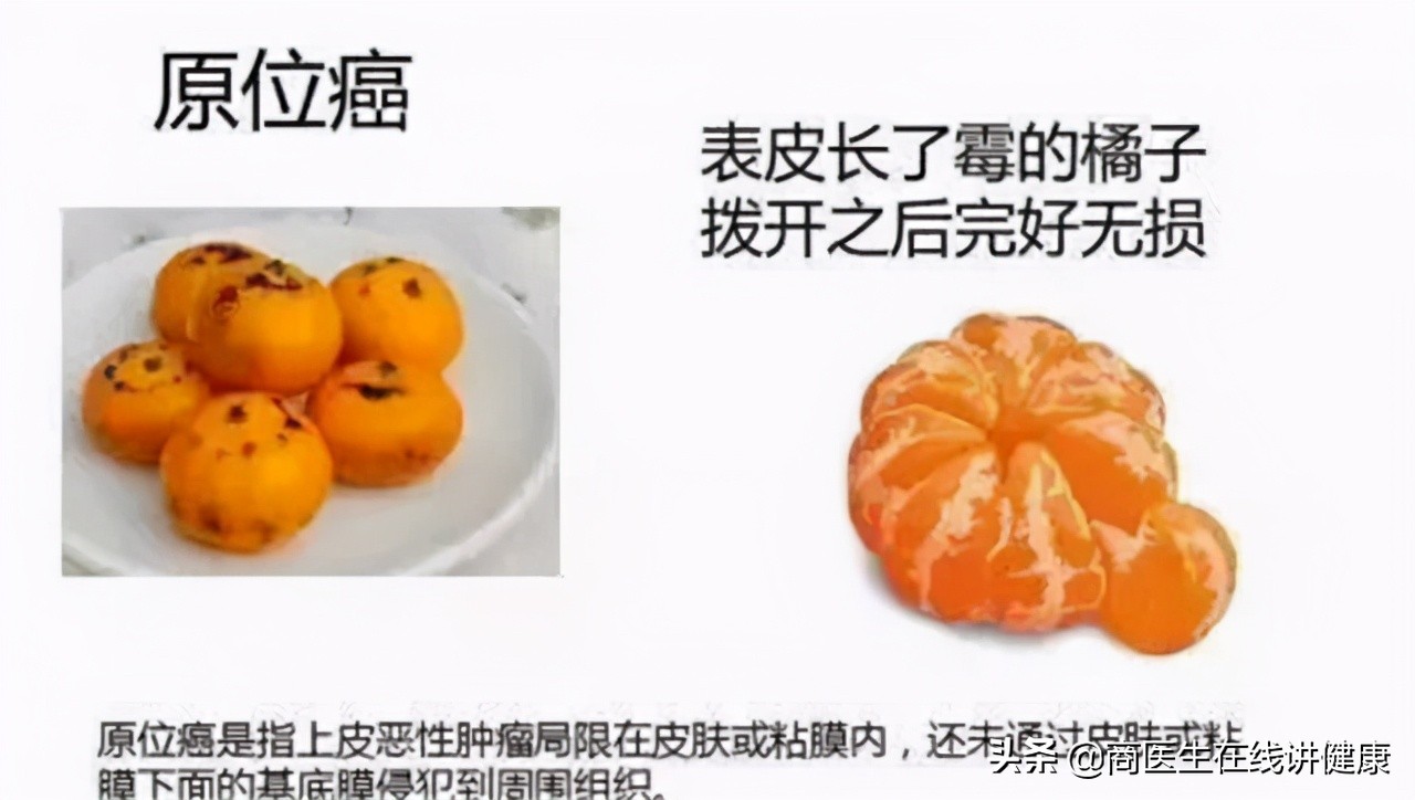 浸润癌是最严重的癌吗,浸润癌恶性