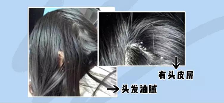天天散着头发容易脱发吗,头发油了特别容易脱发