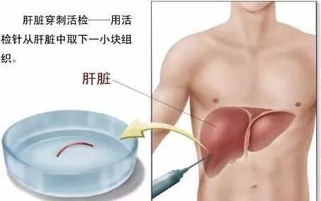 肝穿刺是穿刺好的肝吗,肝穿刺是活检么