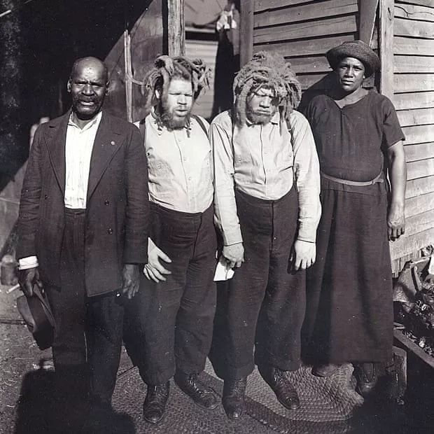 患上白化病不能使黑人免受歧视，他们沦为了同族人的”猎物“