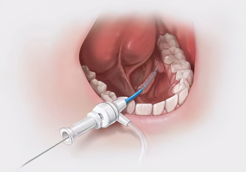 36岁女子一吃饭下巴就痛,这是什么怪病?医生:嘴巴里有个石头