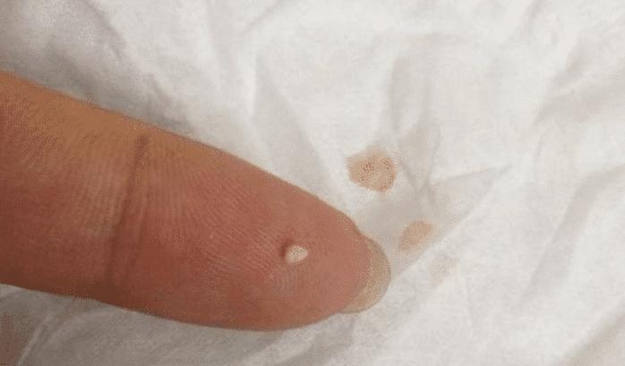 如何彻底消灭在痘痘里的螨虫,痘痘里面有米粒怎么全部去除