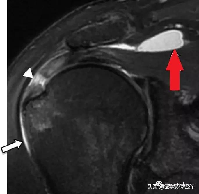 肩关节滑膜解剖,肩关节周围肌肉解剖