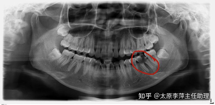 太原整牙齿矫正要多少钱,坏牙齿只剩牙根有必要拔牙吗