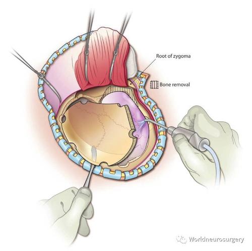 三甲医院医生揭露肿瘤治疗,脑部肿瘤怎么治疗最好