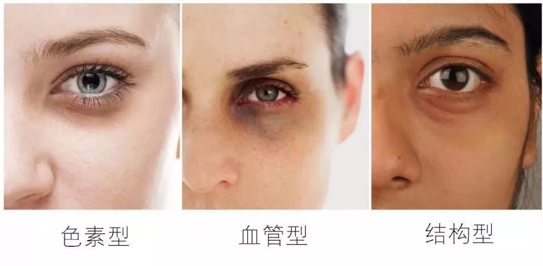 没有熬夜却有黑眼圈怎么消除,没熬夜的黑眼圈怎么去除