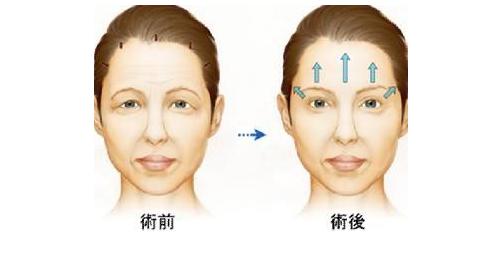 脸上有法令纹去除最好的方法,一般情况最早多大年龄出现法令纹