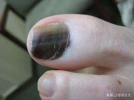 指甲有白点肚子里有蛔虫？月牙越大越健康？指甲软是缺钙……