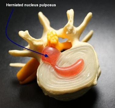 腰椎滑脱和腰椎间盘突出哪个严重,想知道腰椎间盘突出是怎样引起的