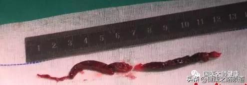 如何让身体不形成血栓,一个动作让血栓变好