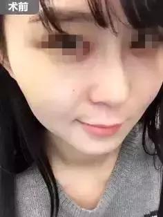 瘦脸针的5个常见问题,瘦脸针其实副作用挺大的