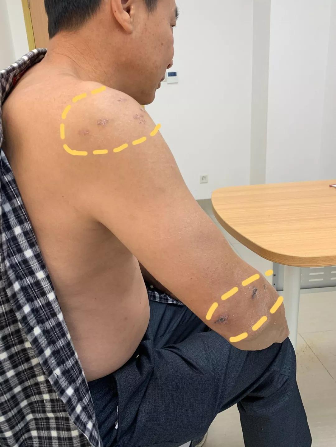 肩袖损伤肘关节旋转康复训练,肩关节损伤治疗微创视频