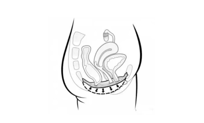产后盆底肌修复案例,产后六七年盆底肌修复最简单动作
